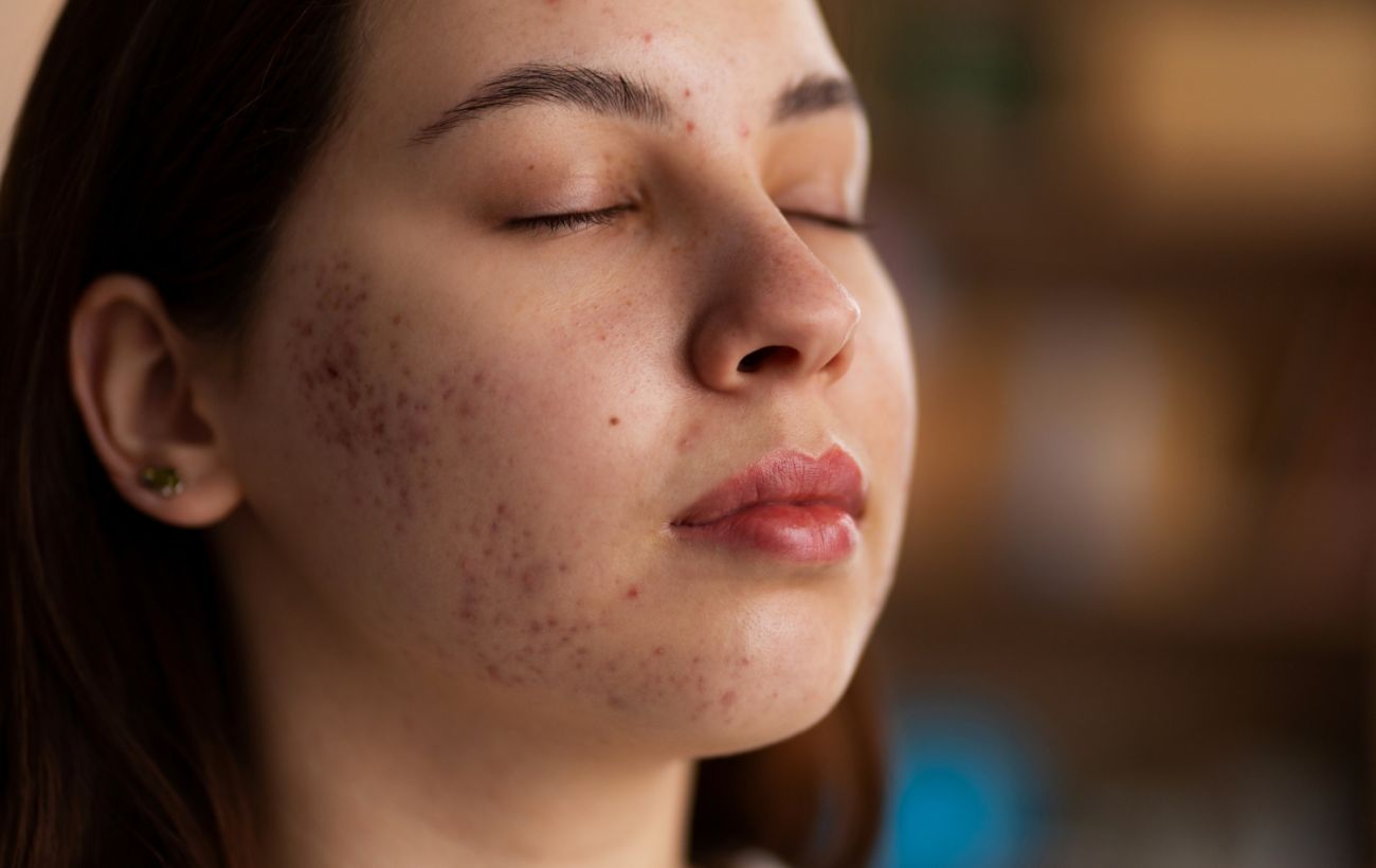 Пять ошибок в уходе, вызывающих акне