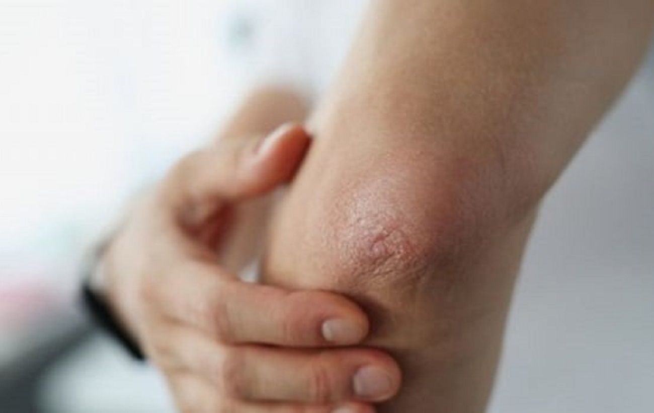 Способы устранения сухости и трещин на локтях для поддержания здоровья кожи