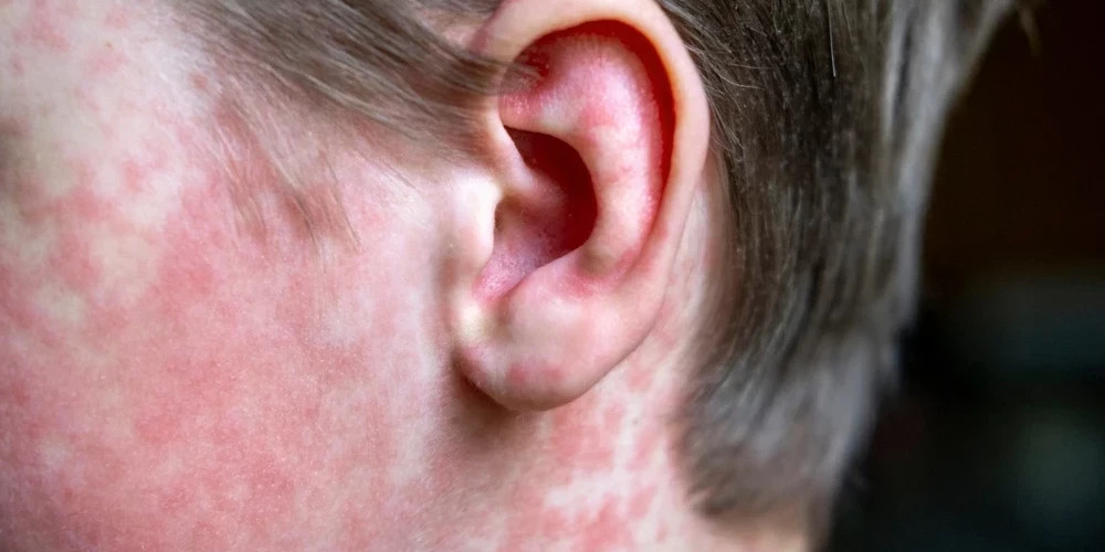 Подтвержденный случай кори в Риге: проводится эпидемиологическое расследование контактов