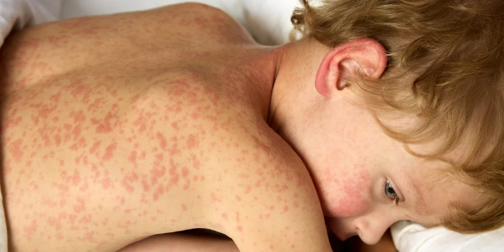 Ситуация с кори в Латвии может ухудшиться из-за низкой вакцинации детей