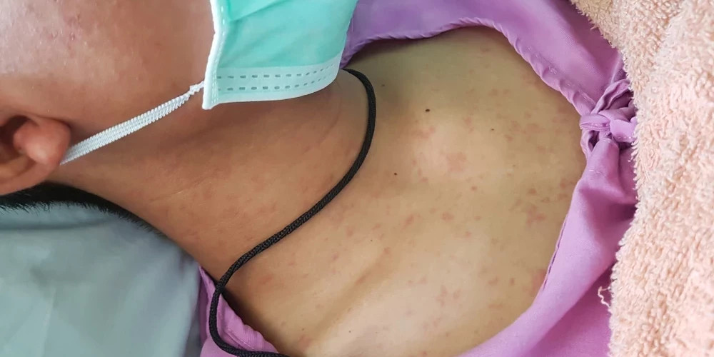 В Латвии фиксируется вспышка кори: зарегистрированы 17 заболевших, риск распространения высок