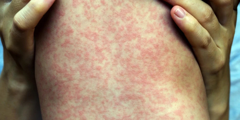 В Латвии предупреждают о серьезных последствиях вспышки кори с 29 зарегистрированными случаями