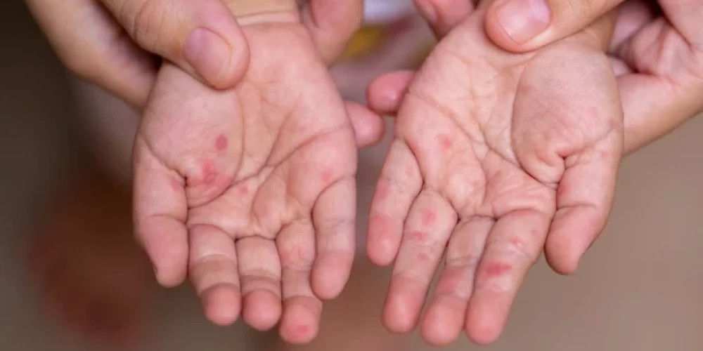 В Риге зарегистрированы еще 23 случая сальмонеллеза в детсадах