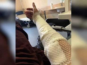 В единственном в Латвии ожоговом центре осталось только пять врачей